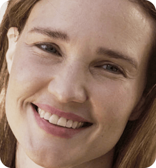 Chemical Peel